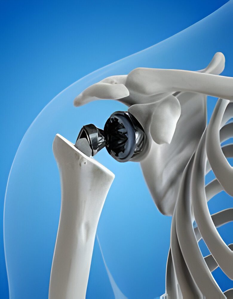 You are currently viewing Must follow our shoulder replacement rehabilitation protocol