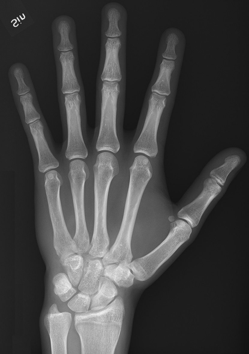 x ray of normal hand by dorsoplantar projectionjpg